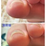 巻き爪当日の変化